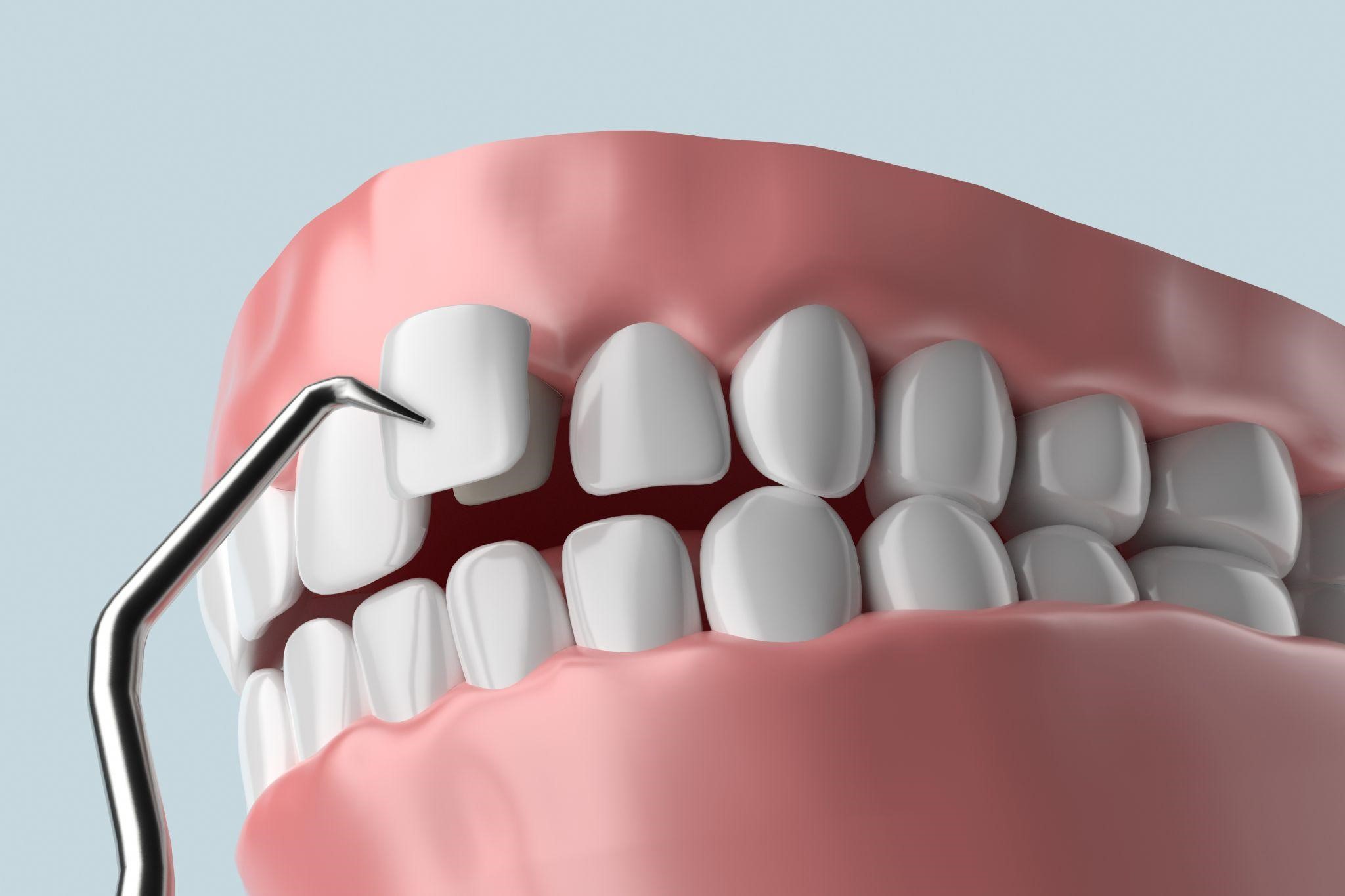Get Perfect-Shaped Teeth With Dental Veneers